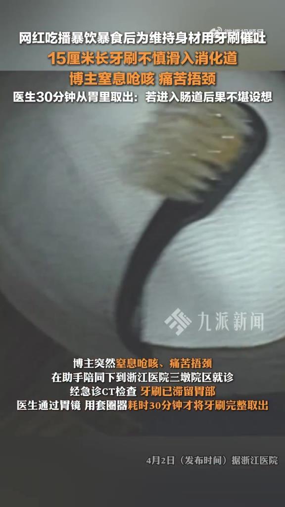 吃播博主牙刷入胃！险象环生，医生 30 分钟成功取出！