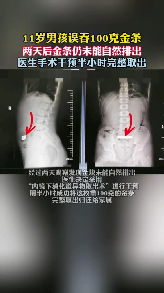 11岁男孩误吞100克金条医生完整取出