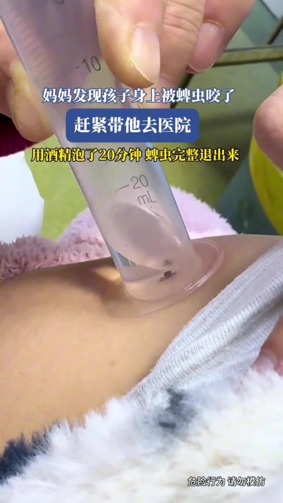 妈妈发现孩子身上被蜱虫咬了,用酒精泡了20分钟,蜱虫退出来了!!