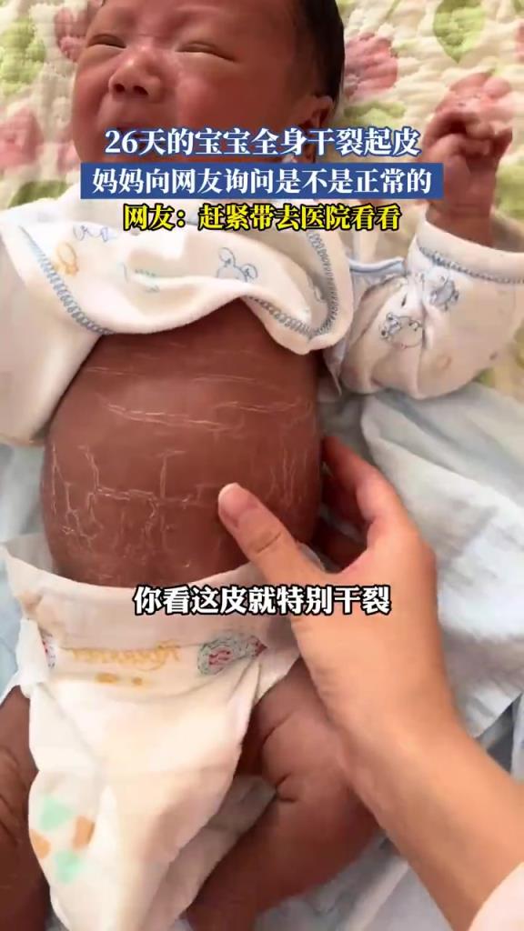 26 天宝宝全身干裂起皮，妈妈急询网友是否正常