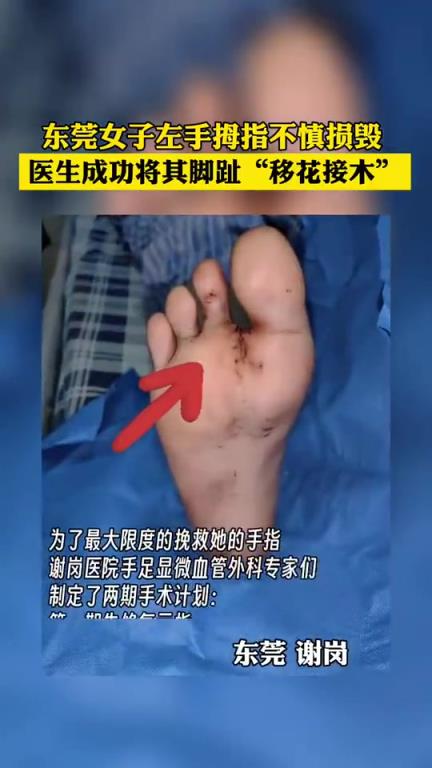 东莞一女子左手拇指损毁，医生成功“移趾接指”