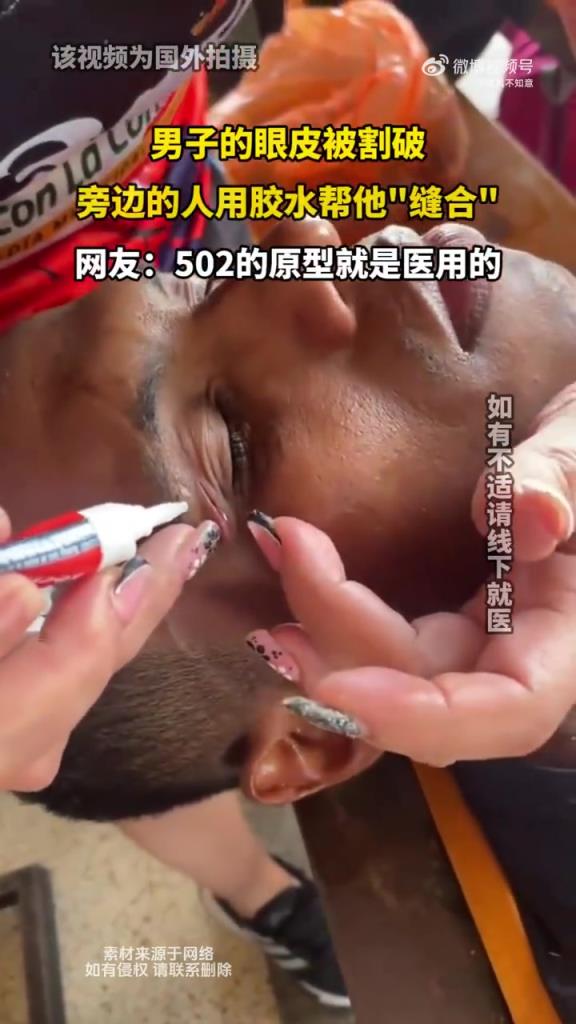 男子的眼皮被割破，旁邊的人用膠水幫他縫合！