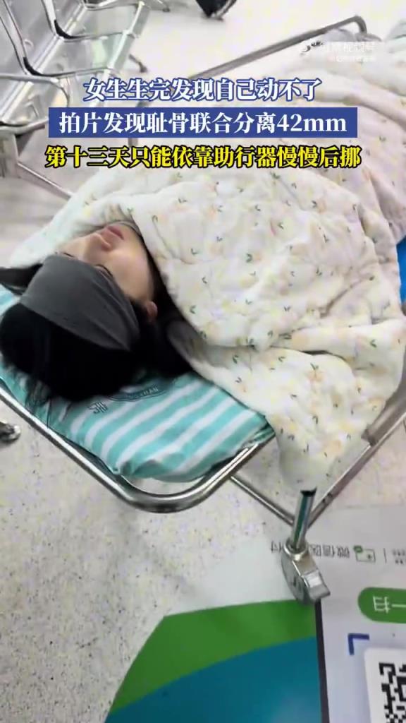 女生生完發現自己動不了，拍片發現恥骨聯合分離42mm