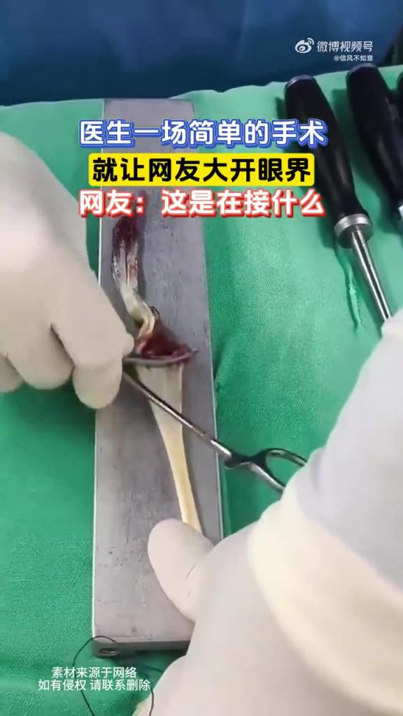 医生一场简单的手术，就让网友大开眼界，网友：这是在接什么？