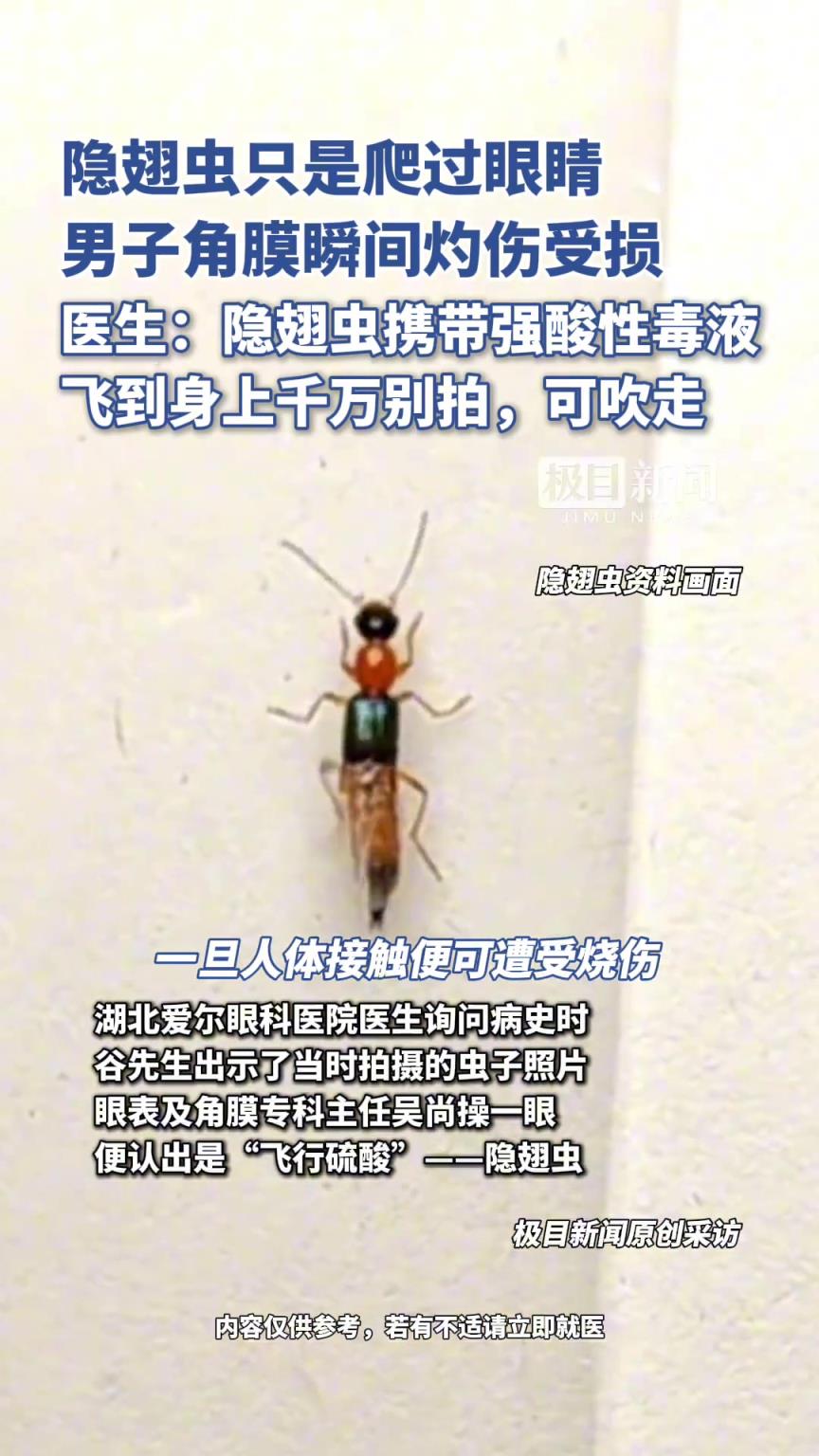 隱翅蟲只是爬過眼睛，男子角膜瞬間灼傷受損