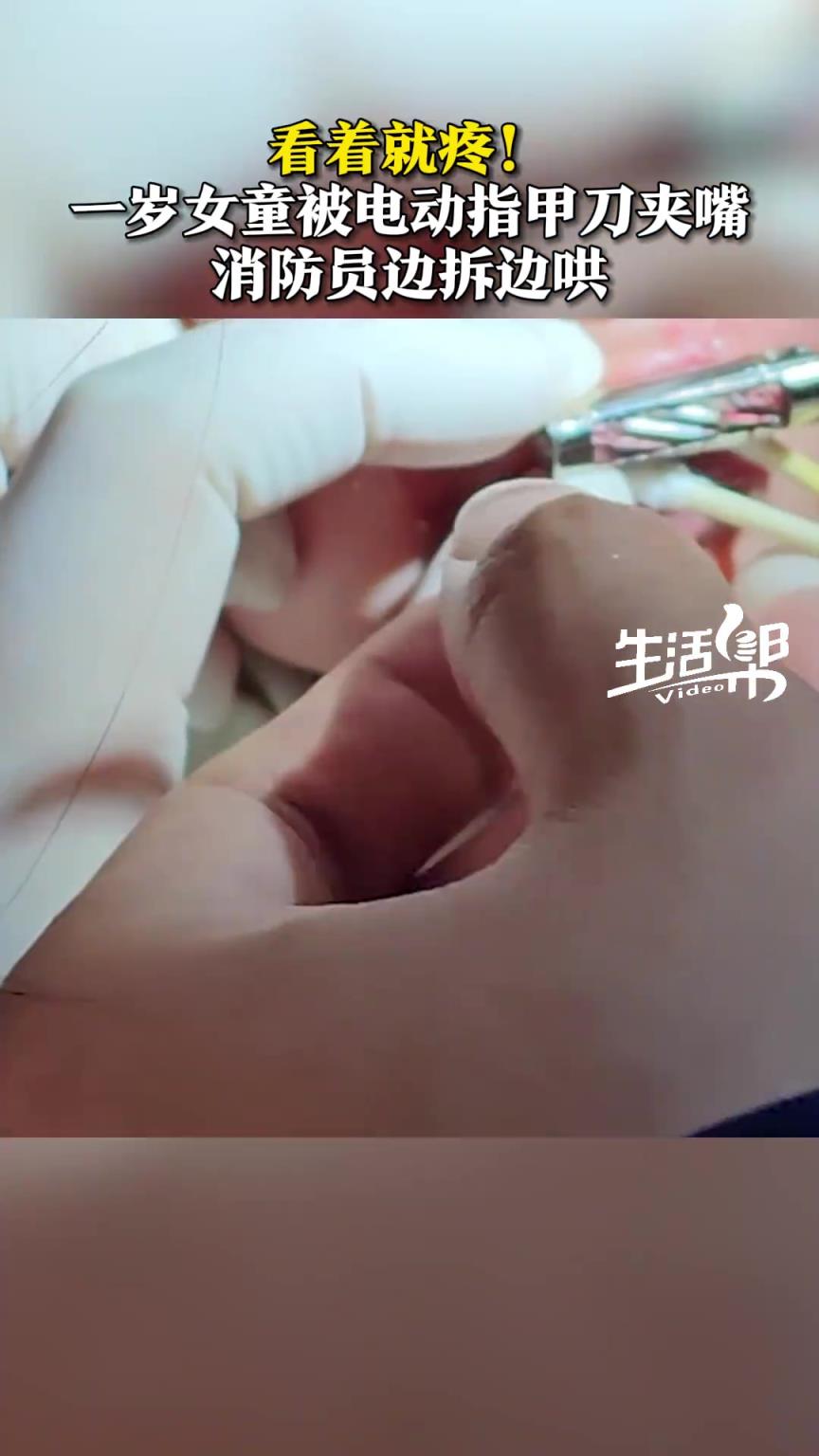 一歲女童被電動指甲刀夾嘴，看著就疼！