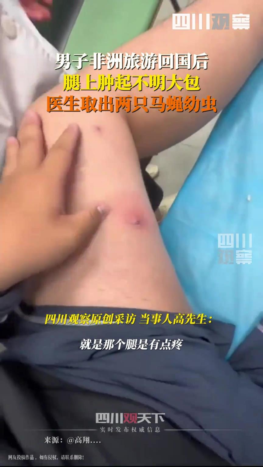 男子非洲旅游回国后腿上取出马蝇幼虫