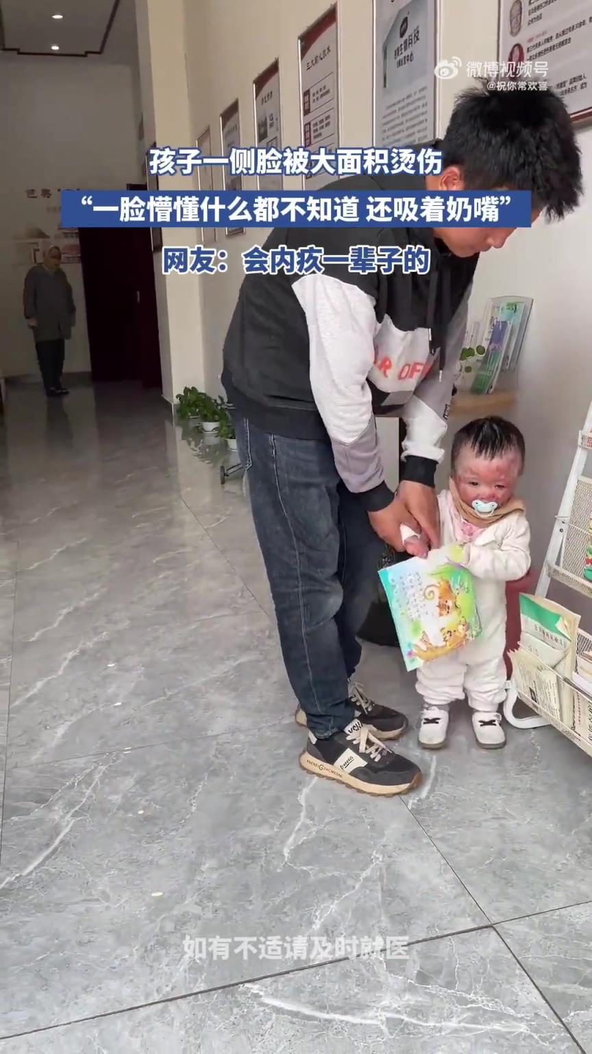 孩子一側臉大面積燙傷，懵懂狀態還吸著奶嘴