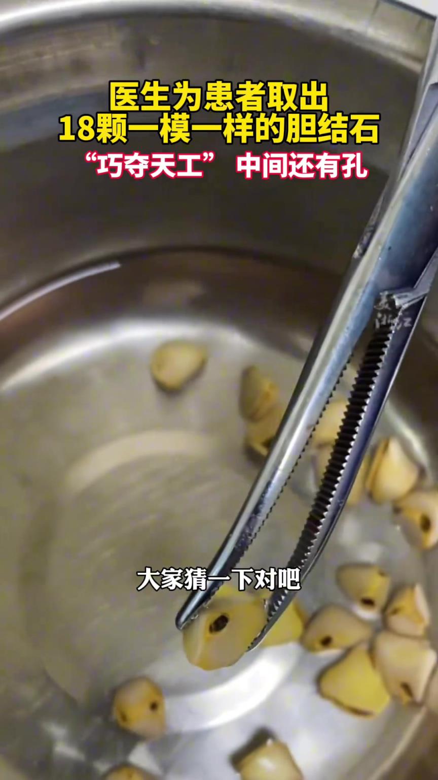 “巧奪天工”醫(yī)生為患者取出18顆一模一樣的膽結(jié)石。