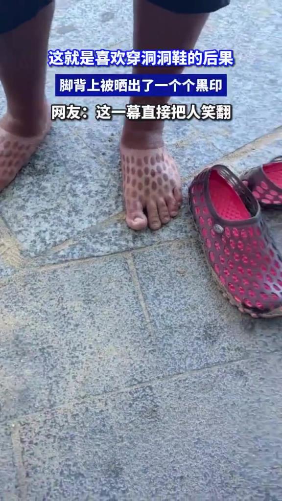 這就是喜歡穿洞洞鞋的后果 腳背上被曬出了一個個黑印