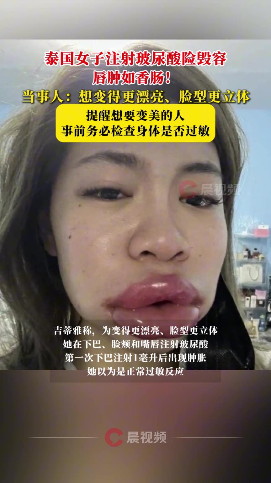 唇腫如香腸！泰國(guó)女子注射玻尿酸險(xiǎn)毀容
