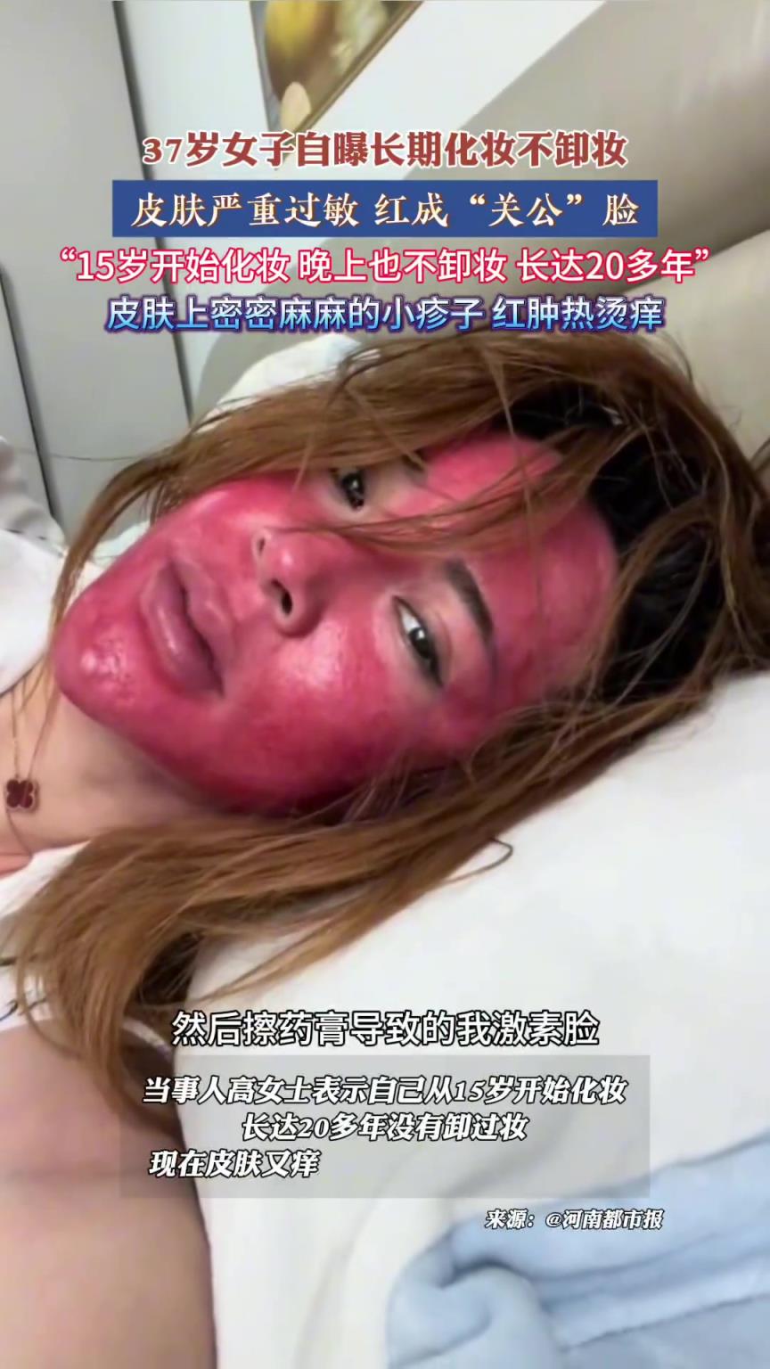 37歲女子自曝長期化妝不卸妝，皮膚嚴重過敏 紅成“關公”臉
