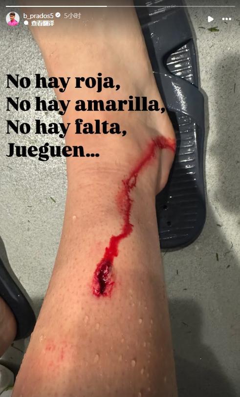 被林德洛夫出球后踢到小腿,畢爾巴鄂中場曬傷口:沒紅黃牌沒犯規(guī) 被林德洛夫出球后踢到小腿,畢爾巴鄂中場曬傷口:沒紅黃牌沒犯規(guī)