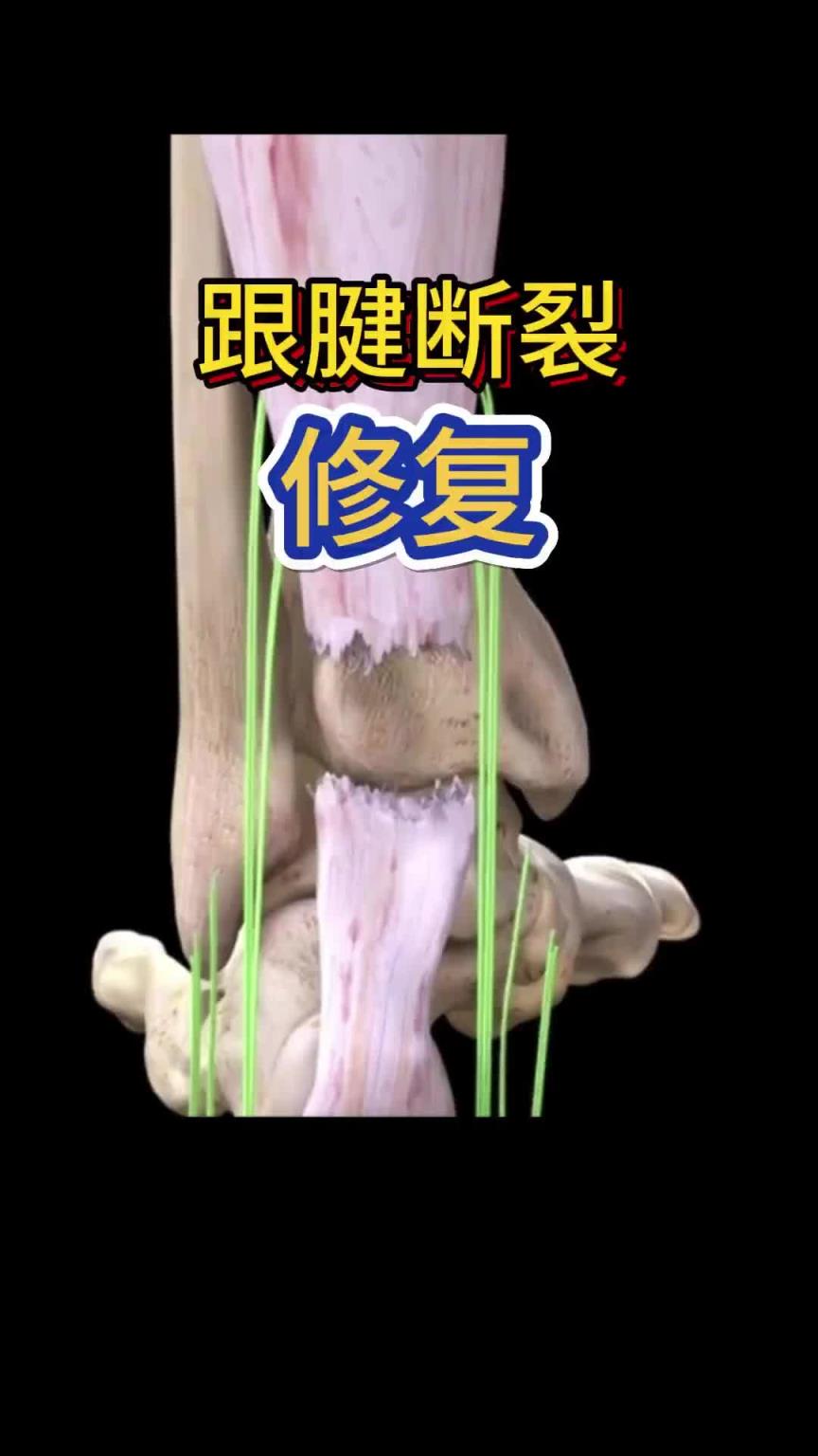 看著都疼??！科普帖：球員腳跟腱斷裂是如何進(jìn)行修復(fù)的？